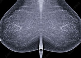 cimi-mammographie-de-depistage-cancer-du-sein-paris-cabinet-radiologie-centre-imagerie-paris-cimi-centre-imagerie-medicale-paris