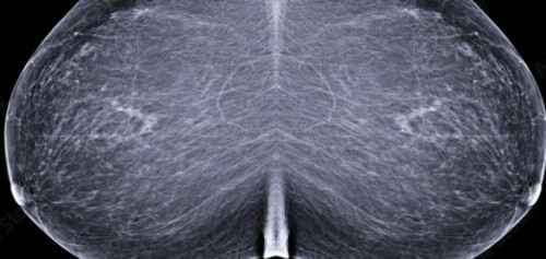 cimi-mammographie-de-depistage-cancer-du-sein-paris-cabinet-radiologie-centre-imagerie-paris-cimi-centre-imagerie-medicale-paris