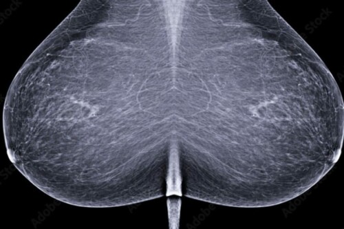 cimi-mammographie-de-depistage-cancer-du-sein-paris-cabinet-radiologie-centre-imagerie-paris-cimi-centre-imagerie-medicale-paris
