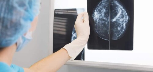 resultat-mammographie-centre-radiologie-imagerie-medicale-paris-cimi-centre-imagerie-medicale-paris-13-radiologue-paris